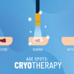 Cryotherapy